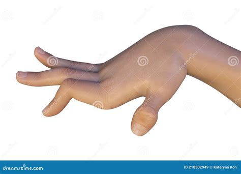 A Hand Of A Child With Chorea, 3D Illustration Royalty-Free Cartoon | CartoonDealer.com #218302949