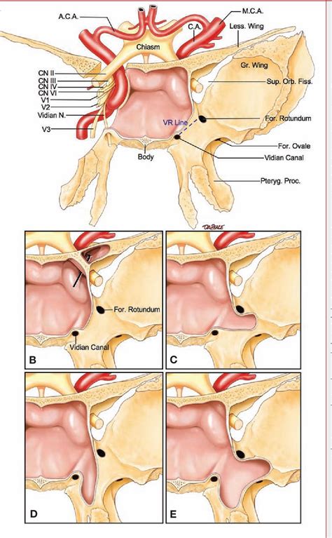 60 Cool Sphenoid Sinus Pneumatization Types Radiology - insectza