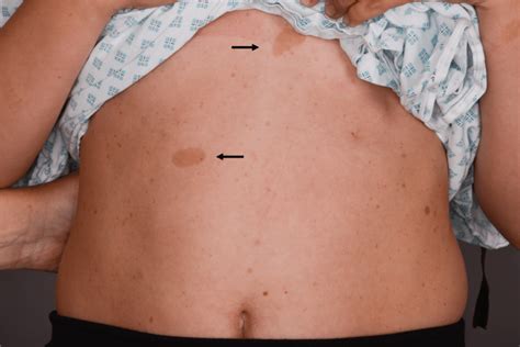 Photograph of the anterior trunk showing two Café-au-lait macules... | Download Scientific Diagram