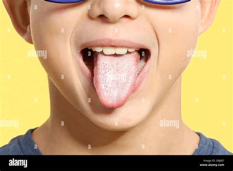 Boy showing tongue with white patches on yellow background, closeup. Oral candidiasis (thrush ...