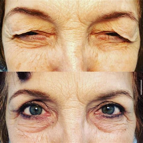 Patient 55495854 | Blepharoplasty (Eyelid Surgery) Before & After ...