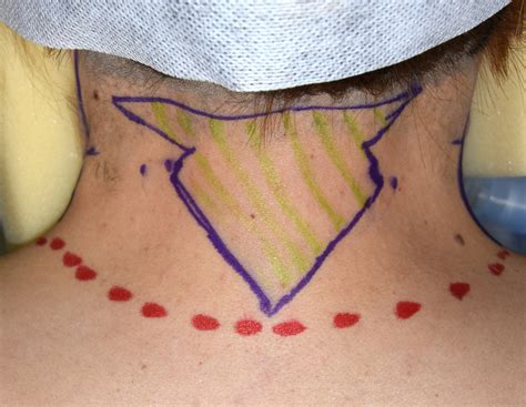 webbed neck surgery diagram Dr Barry Eppley Indianapolis - Explore ...