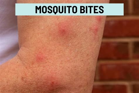 Itchy Bumps On Skin Like Mosquito Bites Causes Treatment Prevention ...