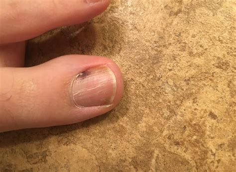 Melanoma under toenail pictures: black spot, nail melanoma pictures ...