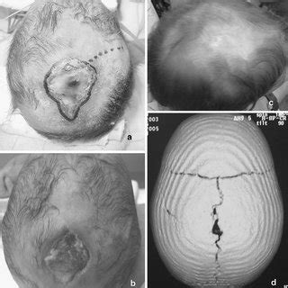 Relevant literature review of Aplasia cutis congenita:... | Download Table