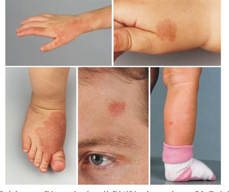 Figure 1 from The potential of capillary birthmarks as a significant marker for capillary ...