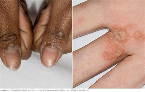 Common warts - Symptoms and causes - Mayo Clinic