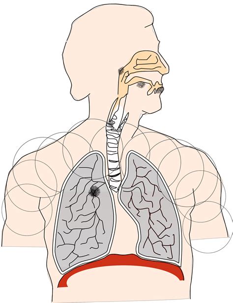 Cancer Caused By Smoking I – PermaClipart