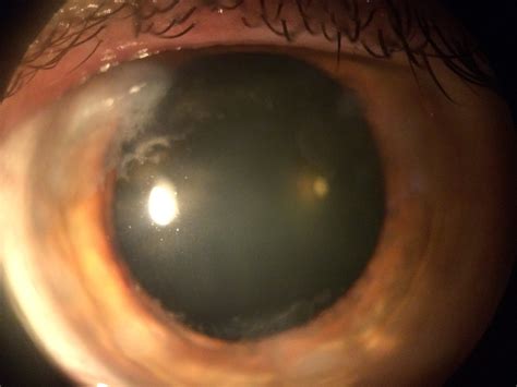 Salzmann's Nodular Degeneration — Moyes Eye Center