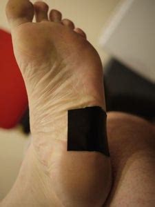 Effective Plantar Wart / Verruca Cure Using Duct Tape Occlusion Therapy (DTOT) - Instructables