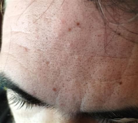 [Routine Help] What's going on with my friends forehead? blackhead and/or tiny hairs? : r ...