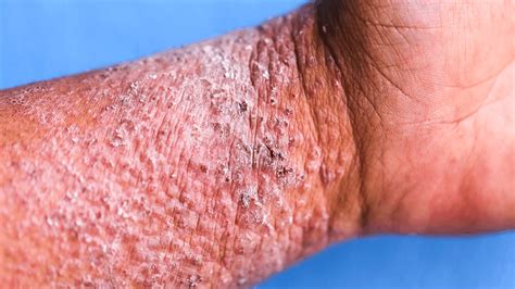 Eczema Rash Look Like