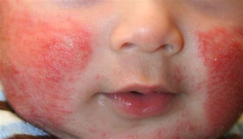 Cashew allergy skin rash babies - bastaeve