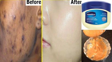 Remove Dark Spots In Just 3 Days With Vaseline | Get Rid Of Uneven Skin tone | Home Remedies ...