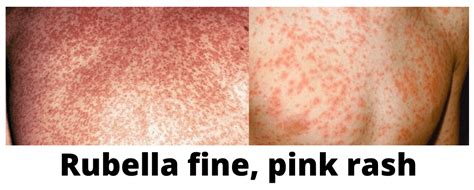 Rubella - Causes, Mode of Transmission, Symptoms and Treatments