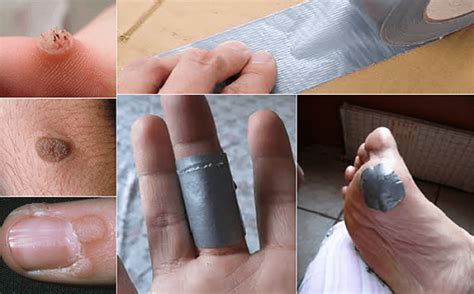 How Does Duct Tape Remove Warts - Paradox