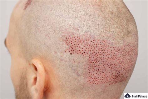 Hair Transplant Holes and Trypophobia | Causes and Treatments