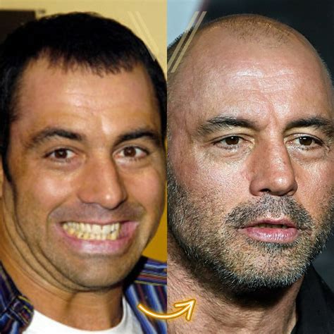 Joe Rogan Hair Transplant: Before and After Transformation