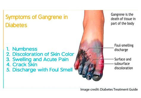 Gangrene in diabetes could lead to amputation, death –Expert - Healthwise