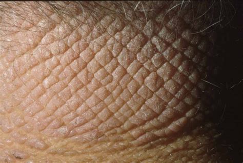 Lichen Simplex Chronicus (Neurodermatitis; Prurigo) - Dermatology Advisor