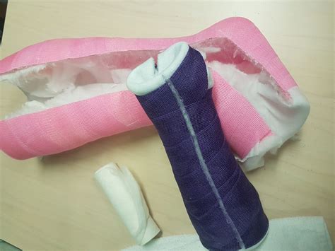 Cast removal, what to expect - little growing bones