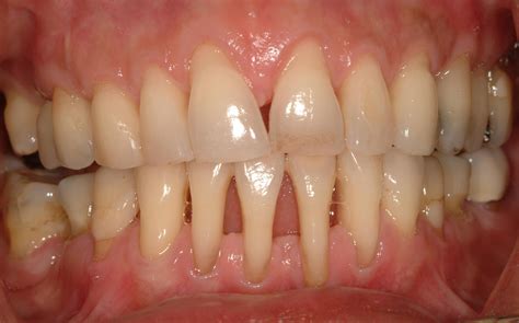 Acute Gingival And Periodontal Conditions Lesions Of - vrogue.co