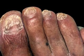 Fungal nail infection - NHS