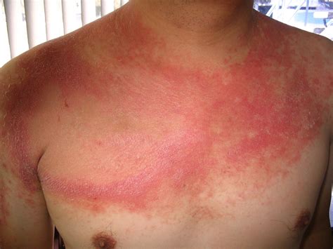 Psoriasis Rash On Stomach