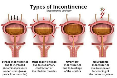 Bladder dysfunction - Life Physio