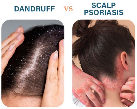 Scalp Psoriasis vs. Dandruff: The Epic Clash You Didn't See Coming