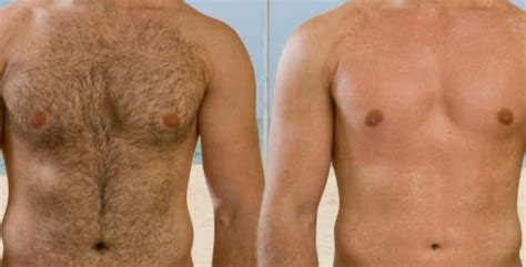 SHR Laser Chest Hair Removal