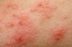 Eczema (Atopic Dermatitis) | Symptoms, Treatment & Management