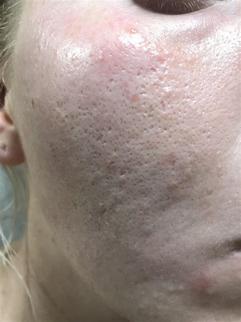 Look at all those blackheads on my face! What’s this condition even called? Lol : r/popping