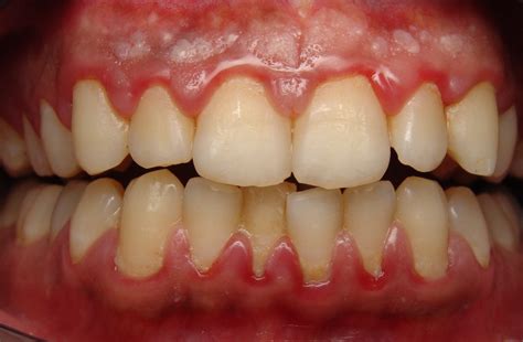 Gum disease? Sounds terrible! What is it? - Dental at Keys
