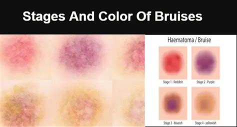 Stages And Color Of Bruises - Body Pain Tips