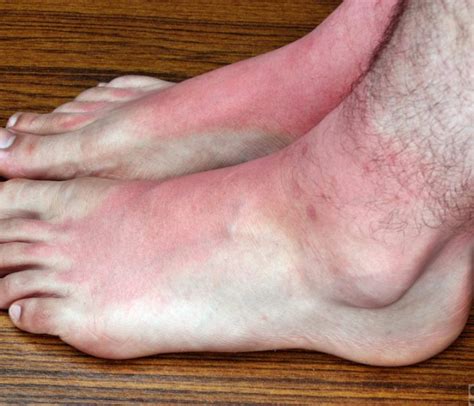 Foot rash | causes, symptoms, home remedies & treatment, pictures