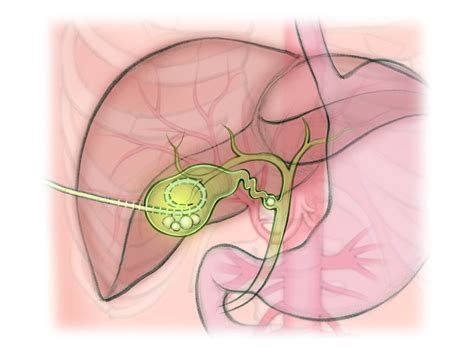 Gallbladder Drain — The Interventional Initiative