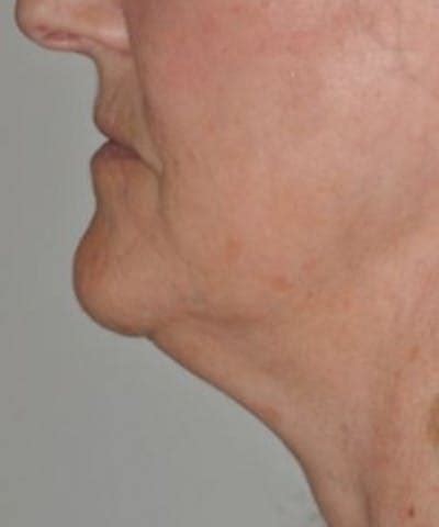 Neck Rejuvenation Before & After Photos | JUVA Skin & Laser Center