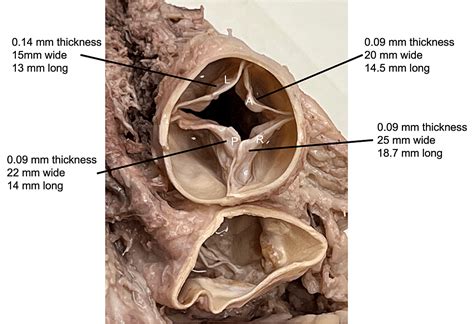 Cureus | Quadricuspid Pulmonary Valve With Fenestration: Cadaveric Findings