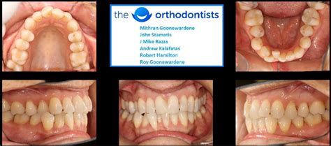 Invisalign Before And After Severe Crowding