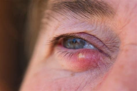 What Causes Stye On Eyelid Fast? - Latest News