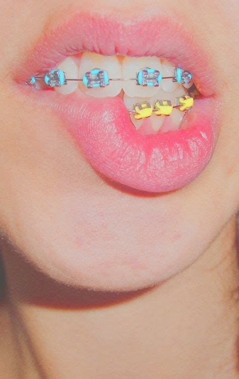 10+ Best braces images in 2020 | braces, braces colors, teeth braces