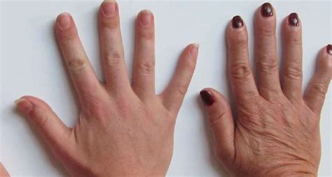 What Causes Veins To Be More Visible in Hands? - Credihealth | Credihealth