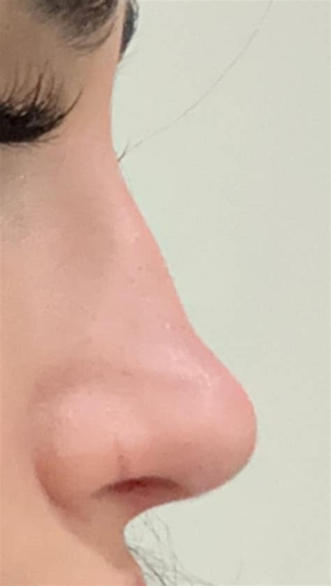 nose bump on bridge 4 months post op (rhinoplasty) is it just swelling ? : r/rhinoplastyquestions