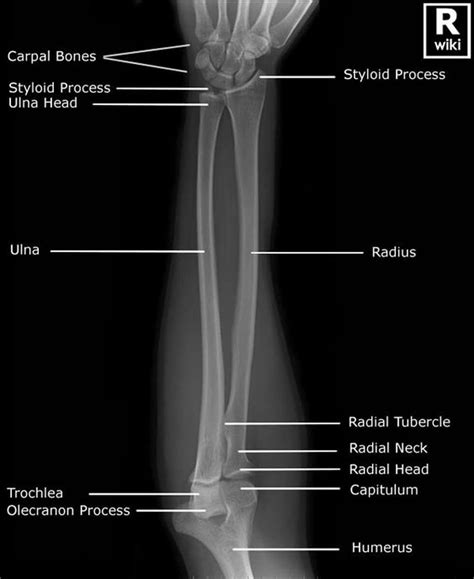 an x - ray image shows the bones and their major skeletal structures ...