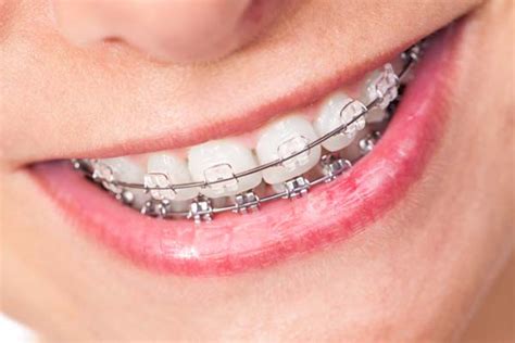 How to Care for Ceramic Braces - Tennison Orthodontics Cleburne Texas