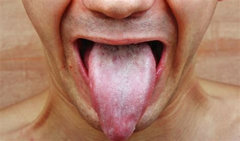 What Are the Causes of Tongue Fungus? | Livestrong.com