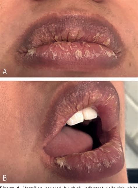 Exfoliative Cheilitis More than an Aesthetic Problem: Case Report ...