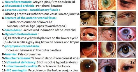 Helps Diagnosis... Some eye disorders with signs.. | General Knowledge