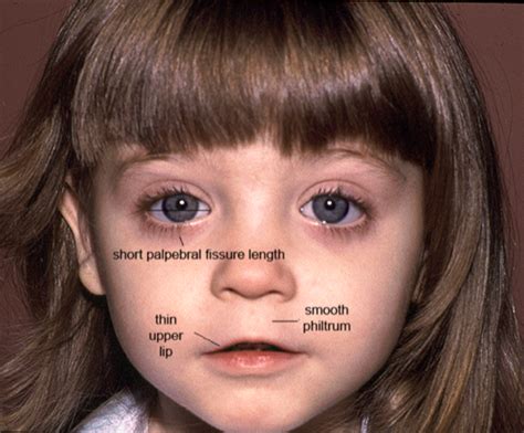 Fetal Alcohol Spectrum Disorder : It’s not all about the face!